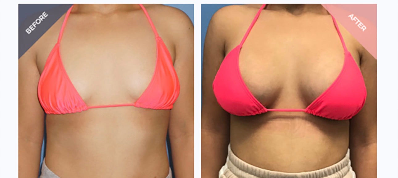 Breast enlargement/Grandi Tête
