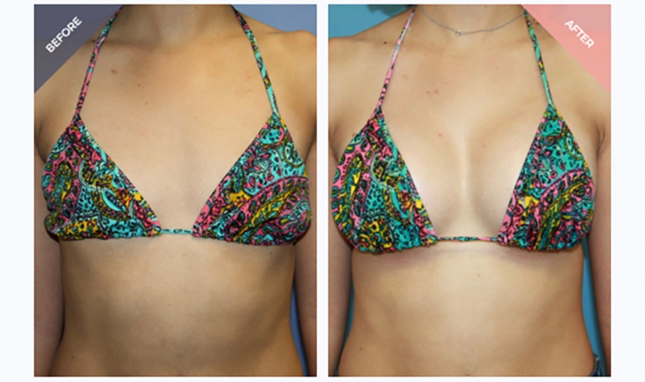 Breast enlargement/Grandi Tête