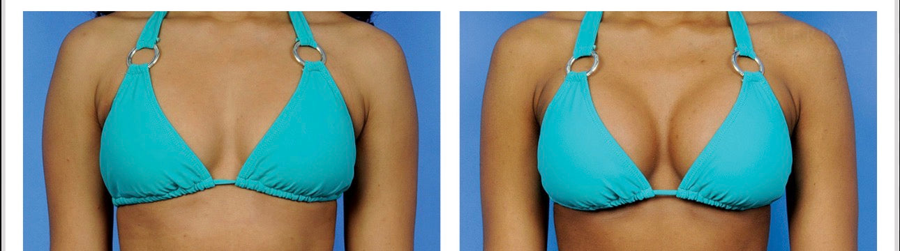 Breast enlargement/Grandi Tête